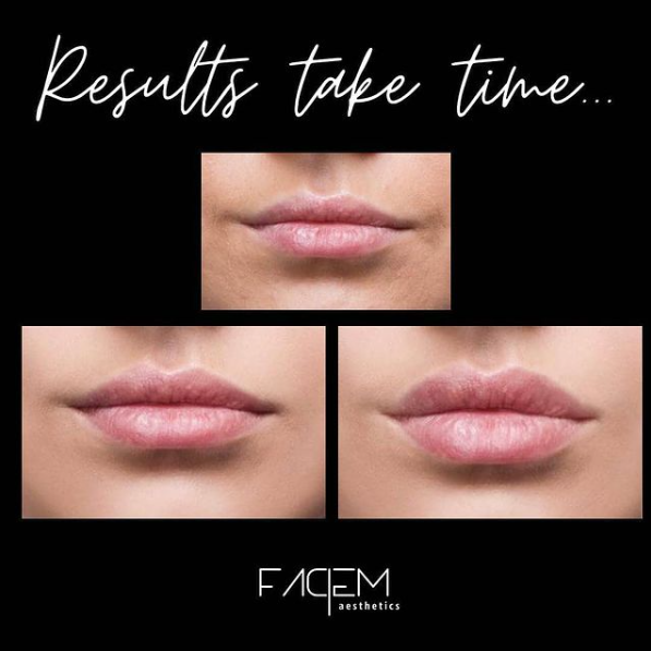 Lip Fillers