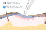 home microneedling treatments - Micro Needling