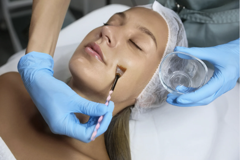 chemical peels