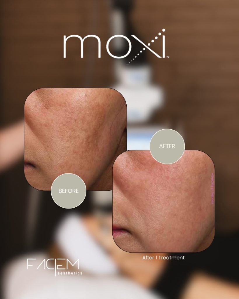 Moxi 1 - MOXI™