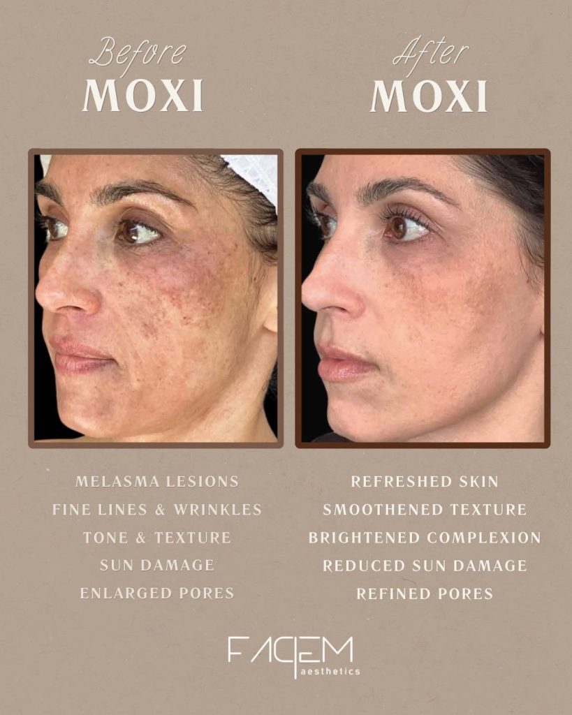 Moxi 2 - MOXI™